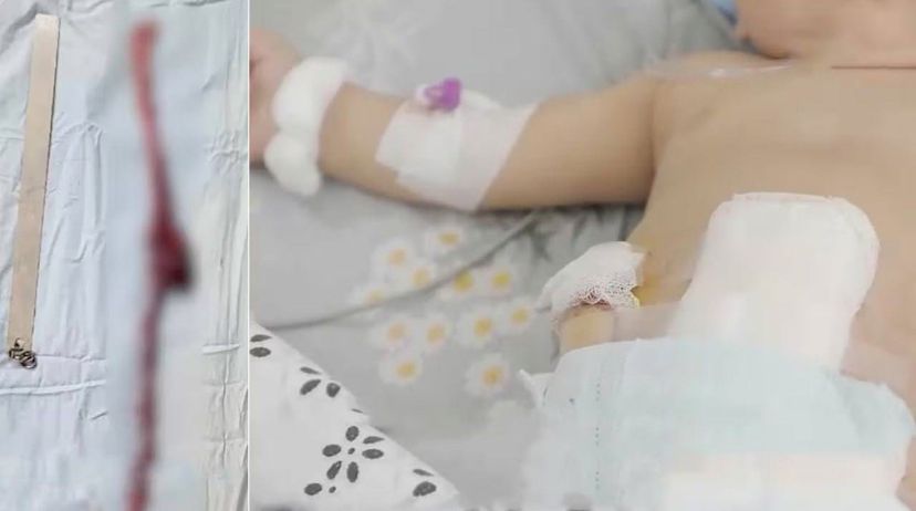 ٶزبەكستاندا 10 ايلىق سەبيدٸڭ شٸرٸپ كەتكەن ٸشەگٸن كەسٸپ الىپ تاستاۋعا تۋرا كەلدٸ — سەبەبٸ فاستفۋد
